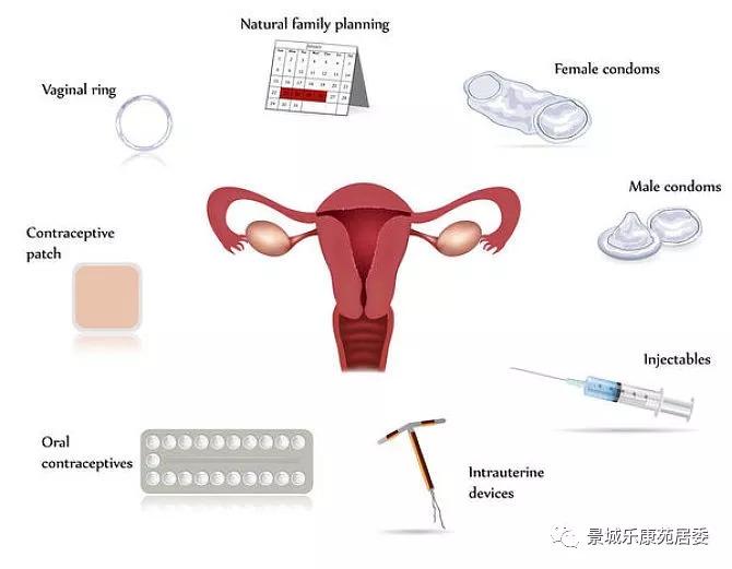 女性最新节育方法，时代选择与科技进步的产物
