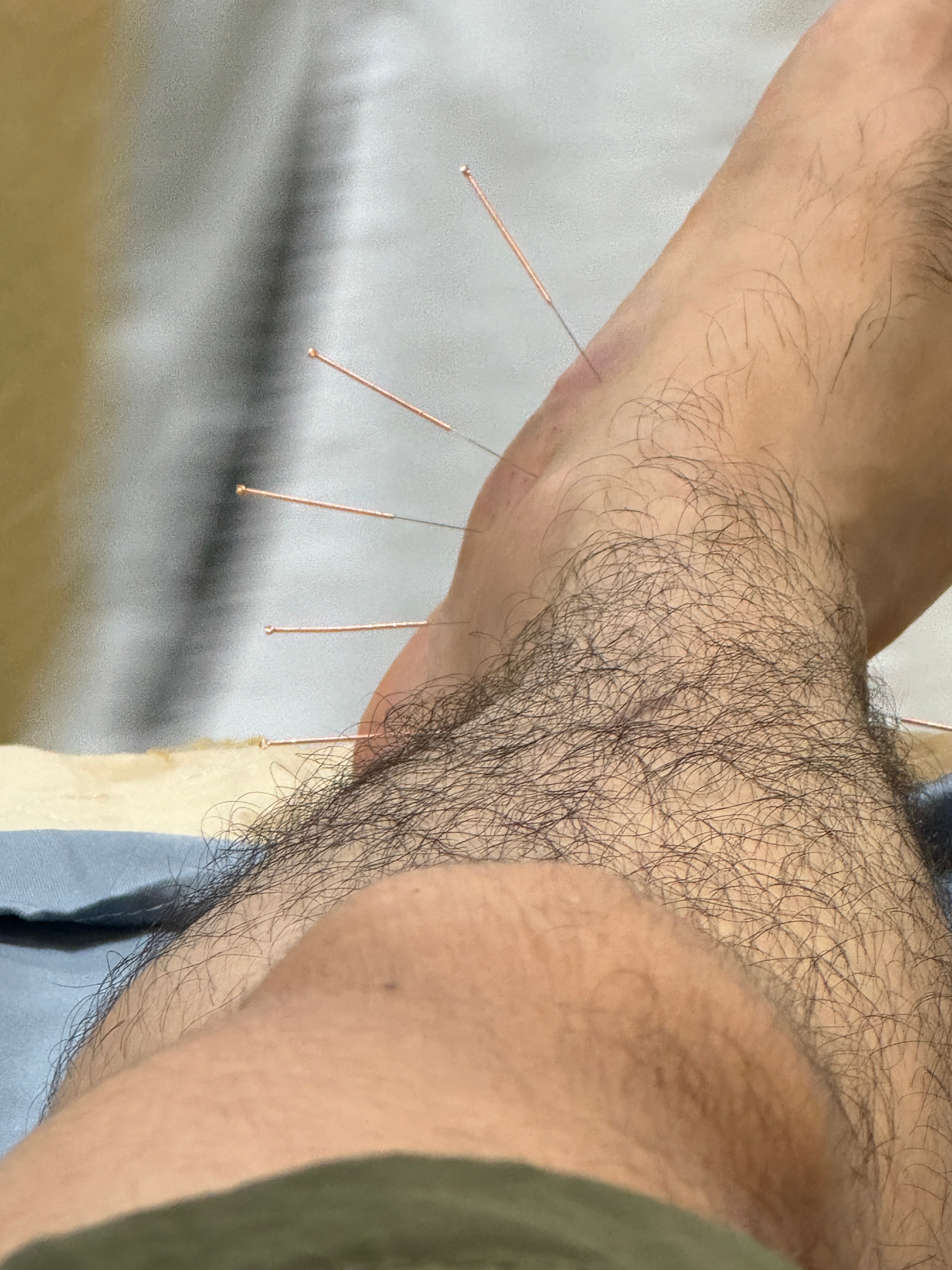 探寻神秘针灸小店,最新针灸视频分享